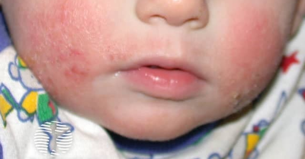 DermNet® - Atopic eczema image