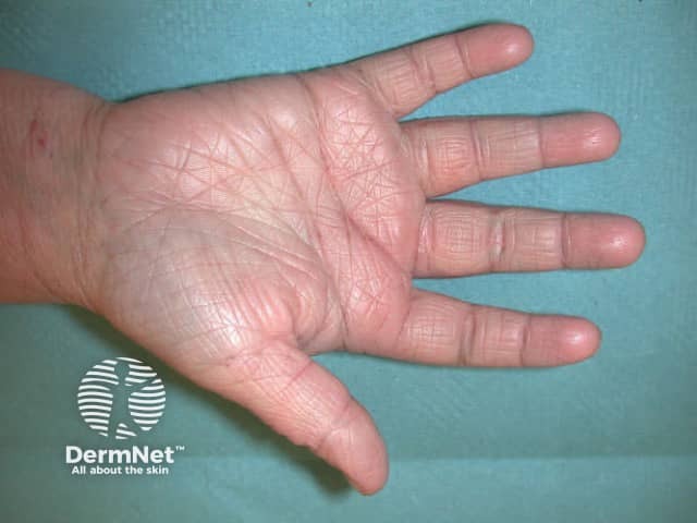 Atopic dermatitis: hyperlinear palm