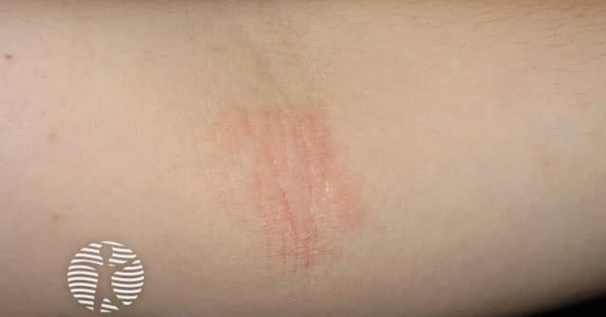 Atopic dermatitis image
