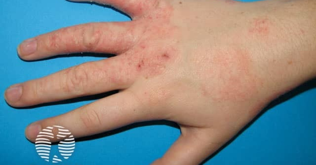 Atopic dermatitis image