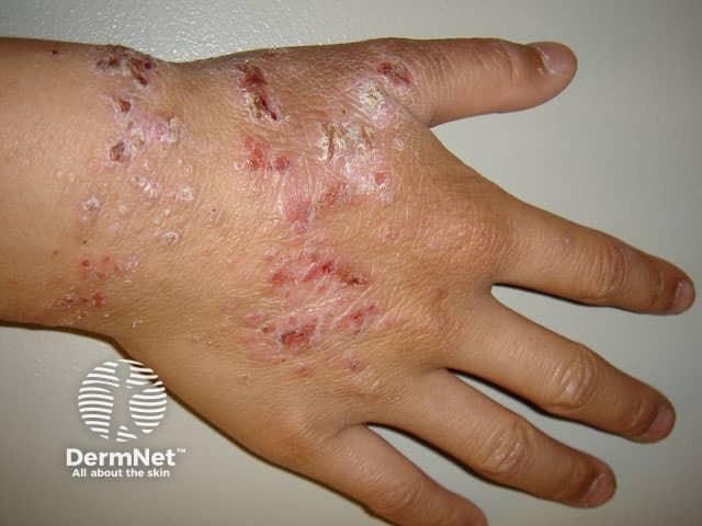 Chronic lichenified atopic hand dermatitis on the back of the hand and wrist