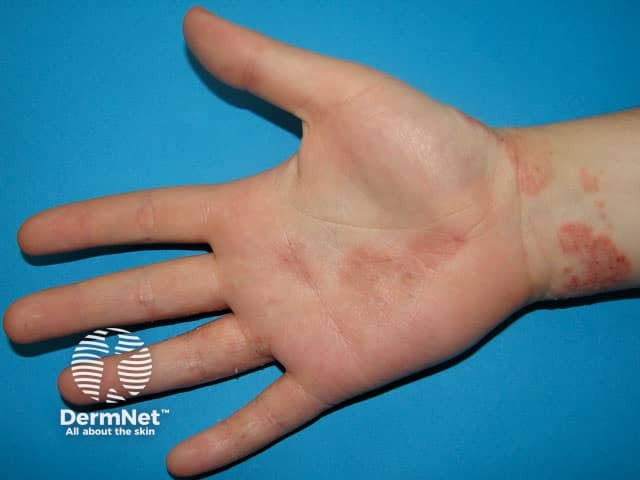 Atopic hand dermatitis involving the volar wrist and palm of hand