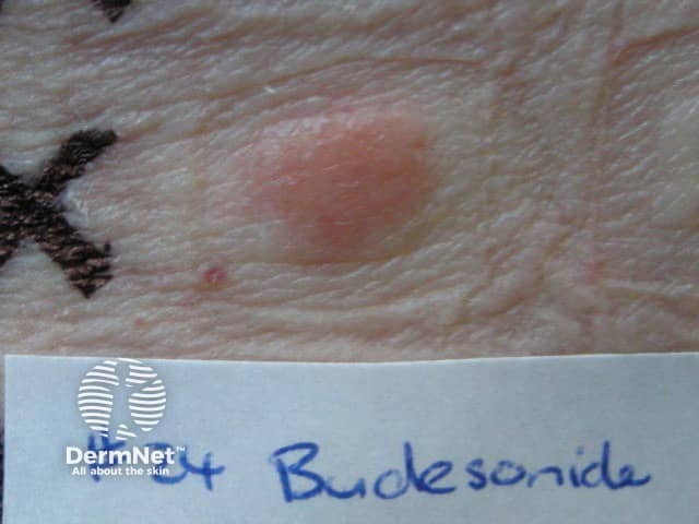 Positive patch test to budesonide