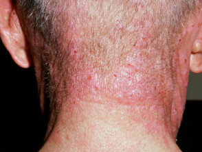 Compositae allergy: airborne dermatitis