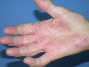 Compositae allergy: hand dermatitis