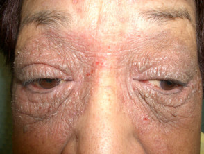 Compositae allergy: eyelid dermatitis