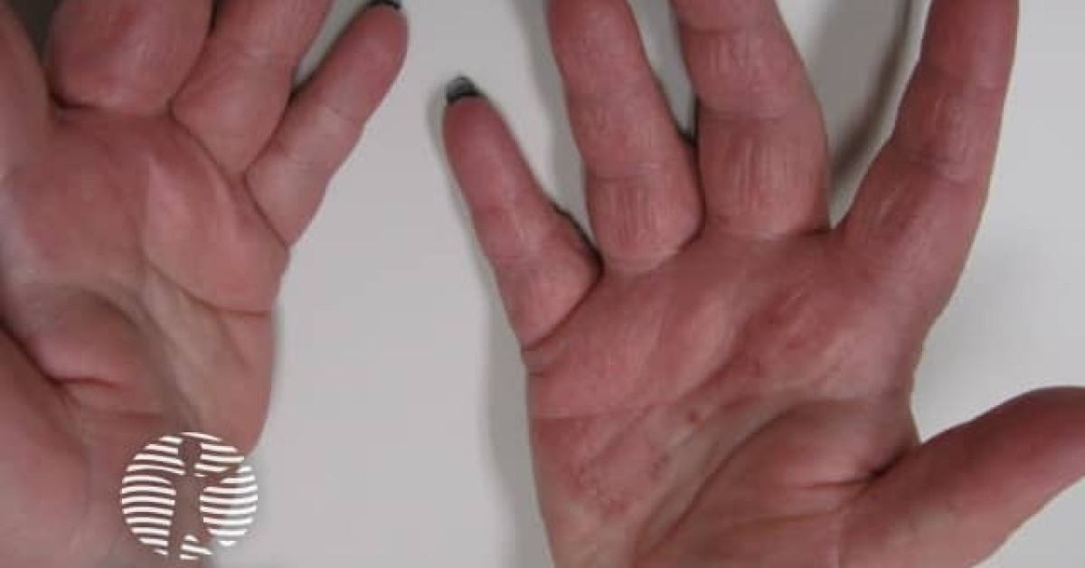Computer mouse dermatitis image