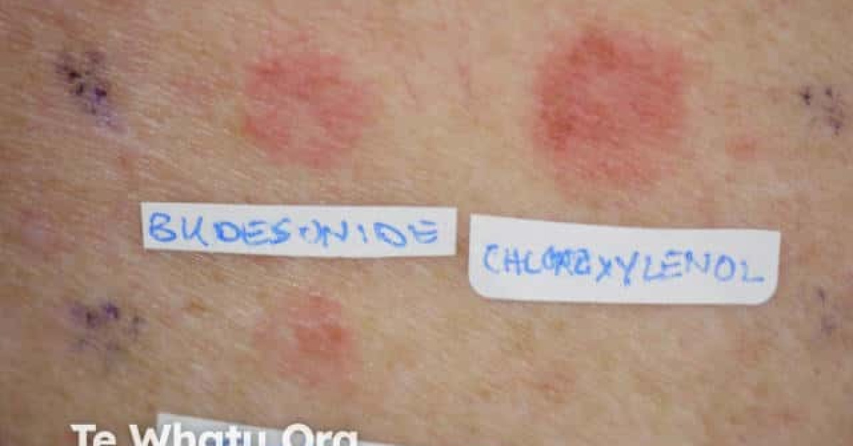 Positive patch test to topical corticosteroids image