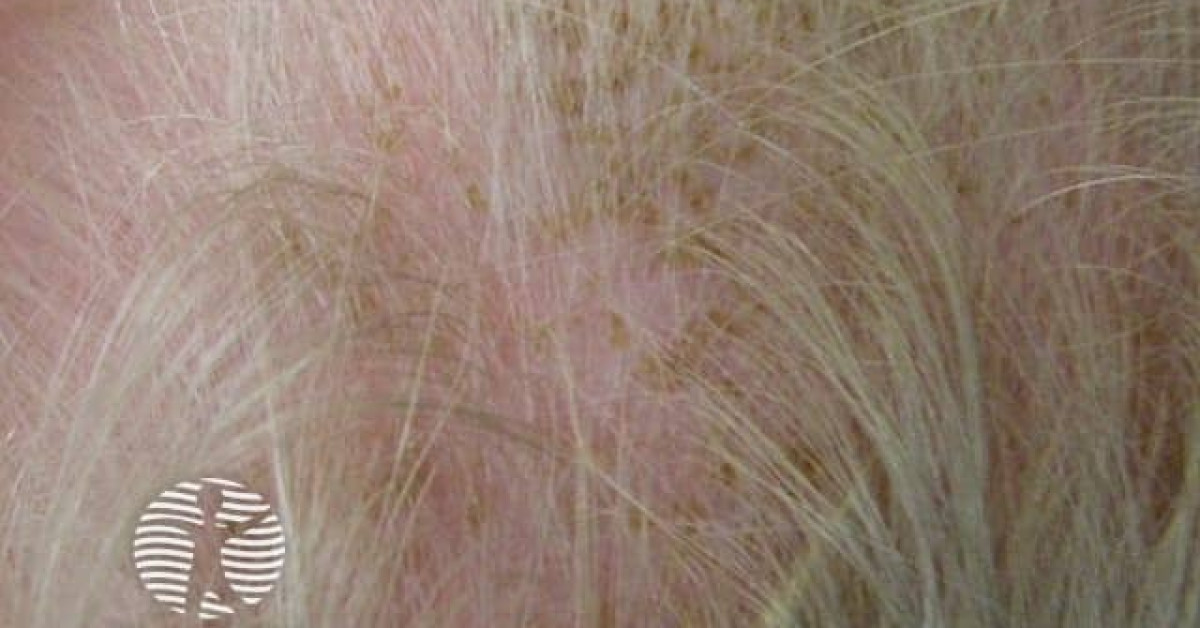 Cradle cap image