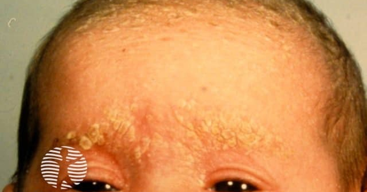 DermNet® - Cradle cap image