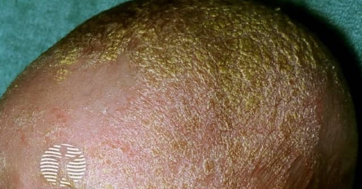 Cradle cap image