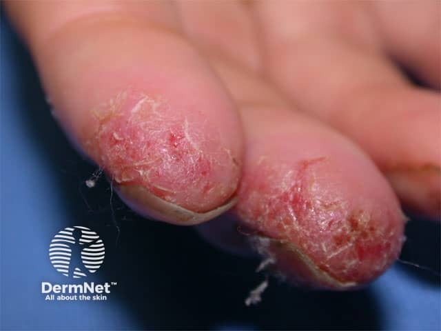 Hand dermatitis due to