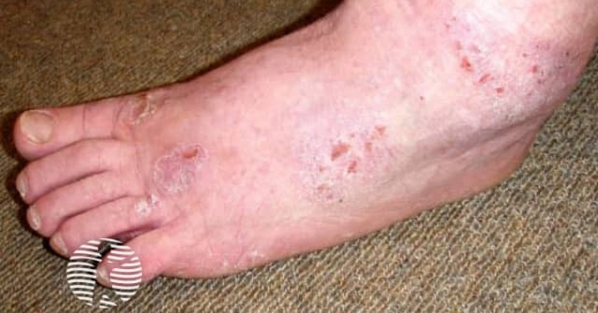 Contact dermatitis due to neoprene and diethylthiourea