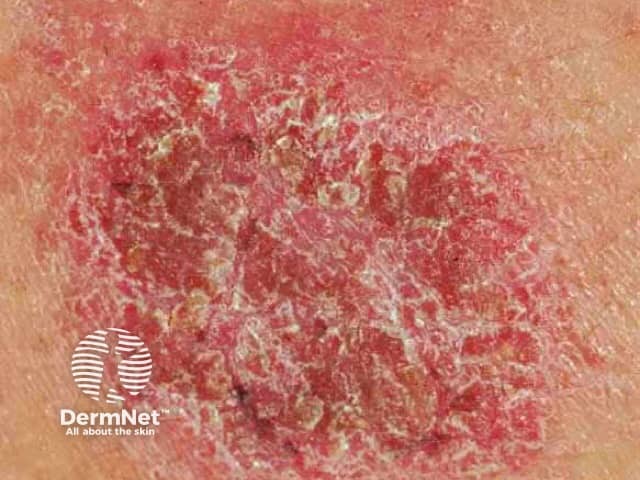 Dermatitis from dry skin