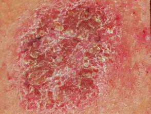 Discoid eczema