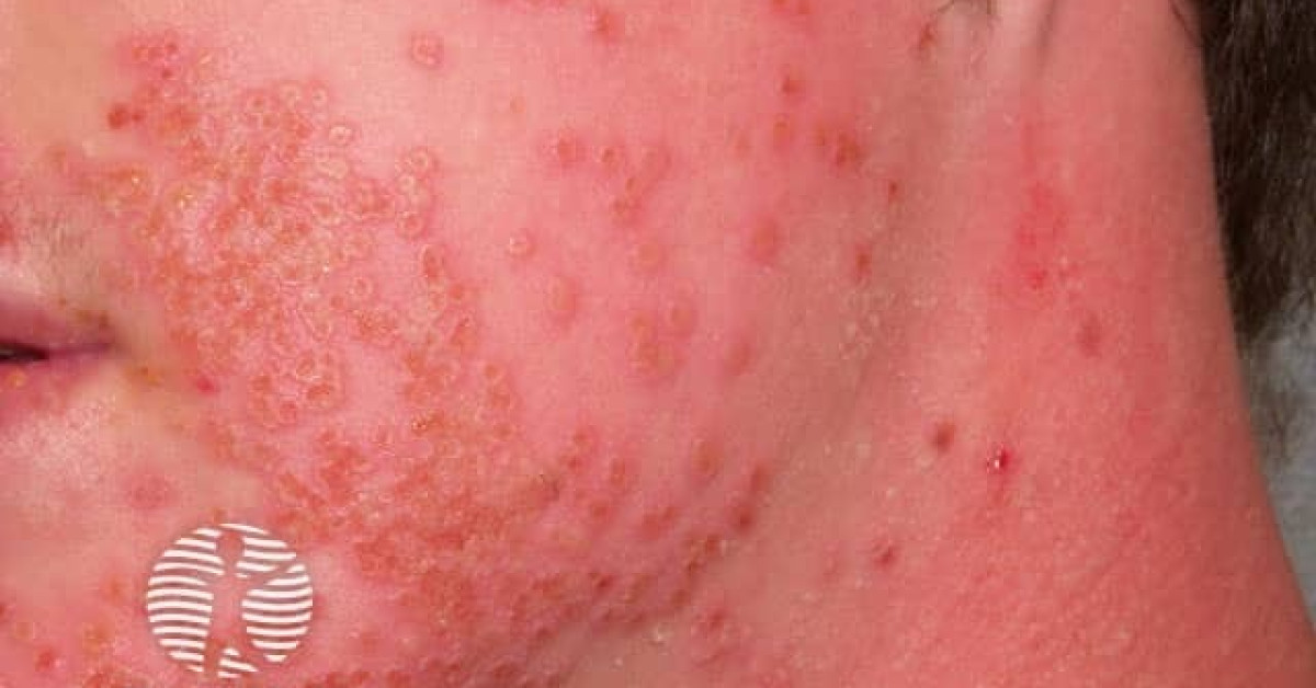 Eczema herpeticum image