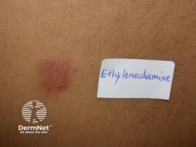 Contact dermatitis to ethylenediamine