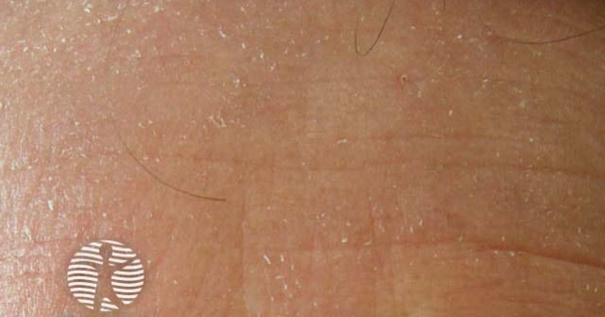 Eczema image