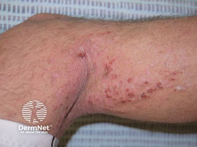 Lichenified flexural atopic dermatitis