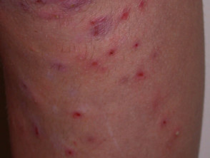 Infected dermatitis