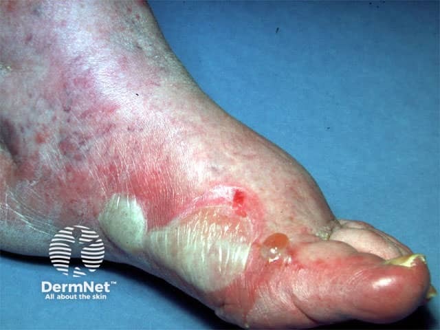 Foot dermatitis