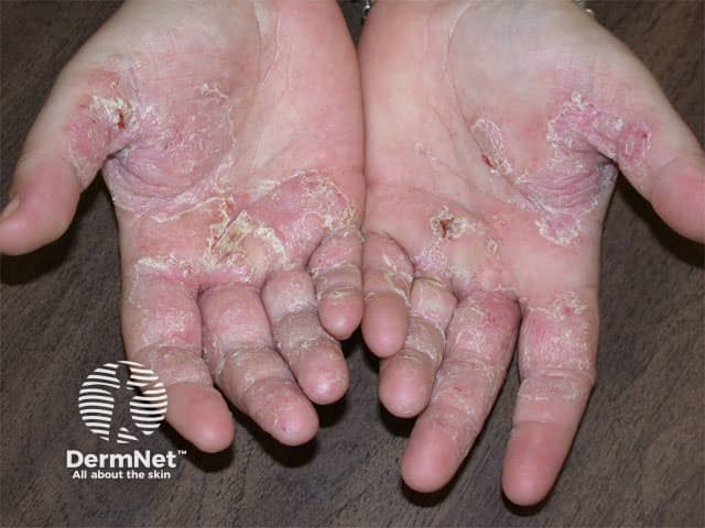 Chronic hand dermatitis in chrome allergic patient