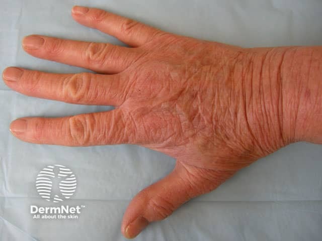 Hand dermatitis caused by gloves