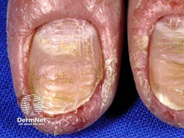 Nail dystrophy secondary to fingertip dermatitis