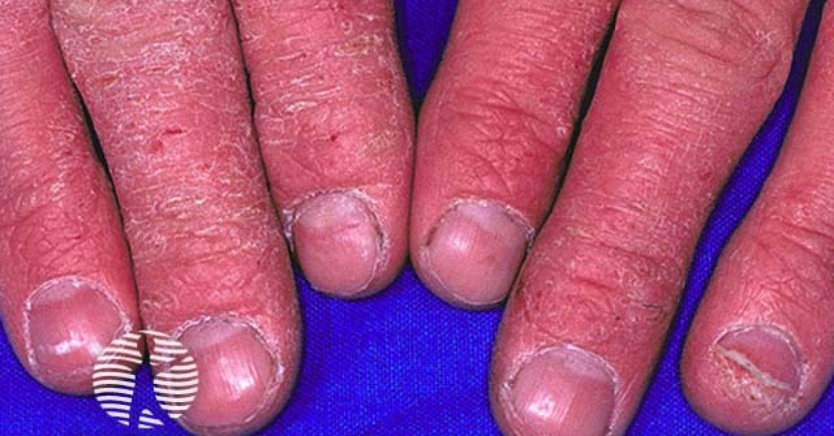 Hand Derma Hand dermatitis image