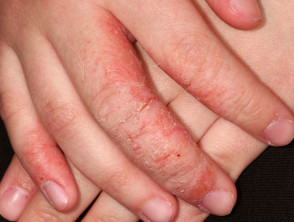 contact dermatitis fingers