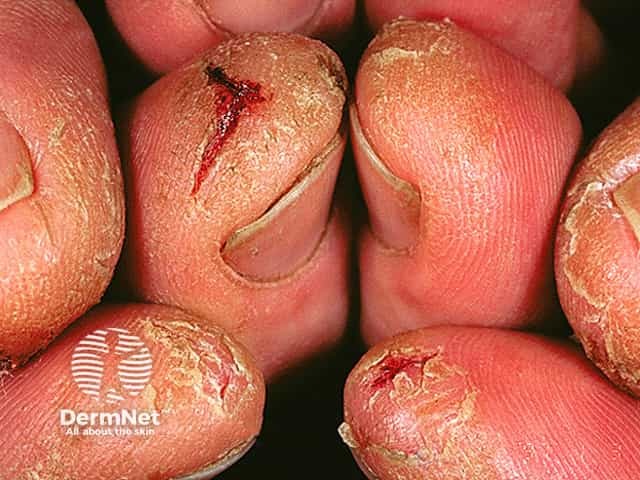 Hand dermatitis on fingers