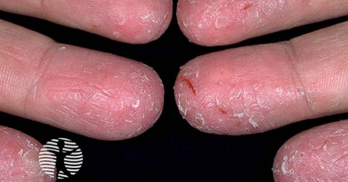 Hand Derma Hand dermatitis image