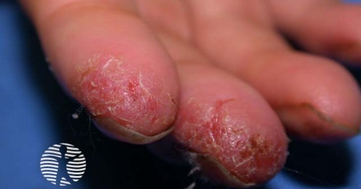 Hand Derma Hand dermatitis image