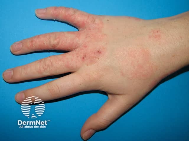 Irritant hand dermatitis