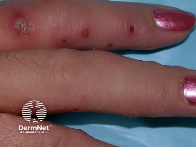 Staphylococcal infected eczema