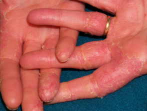 Irritant dermatitis