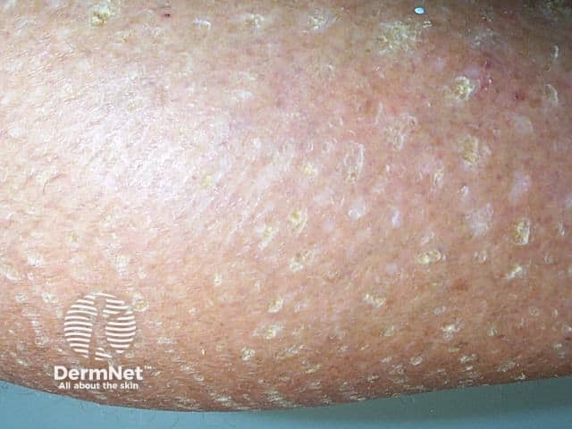 Close-up of ichthyosis
