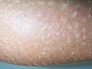 Dry Skin Dermnet Nz