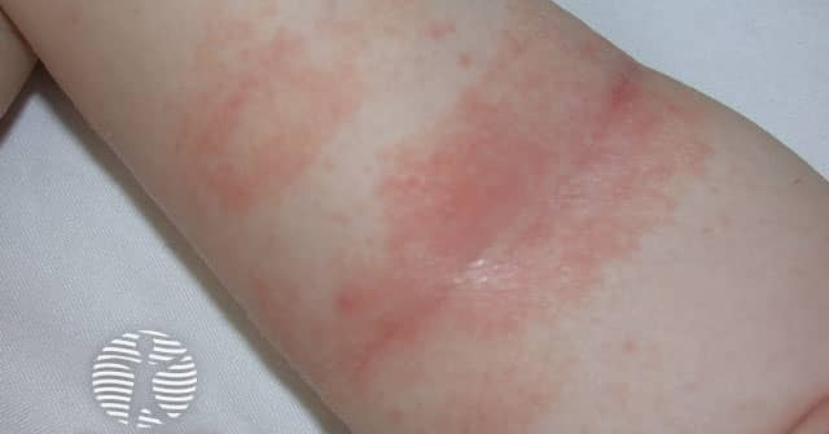 DermNet® - Seborrhoeic dermatitis image