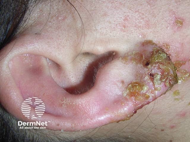 Infected earring reaction