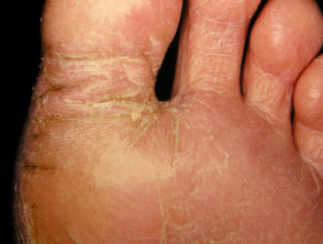 skin fissure foot