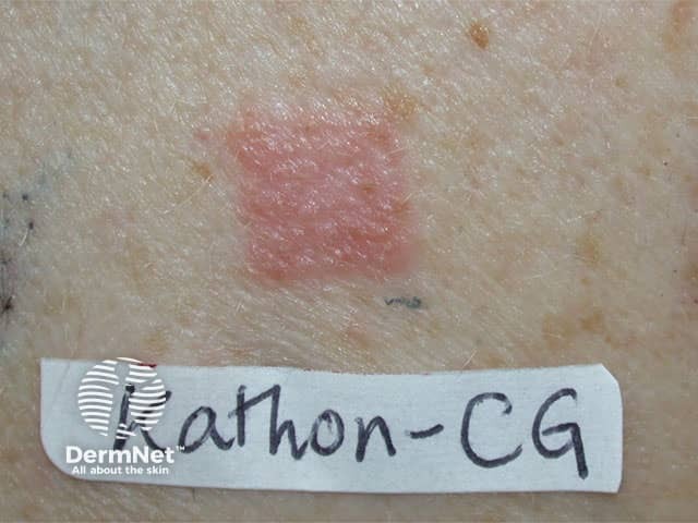Positive patch tests