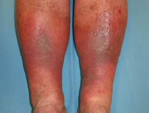 Venous eczema and lipodermatosclerosis