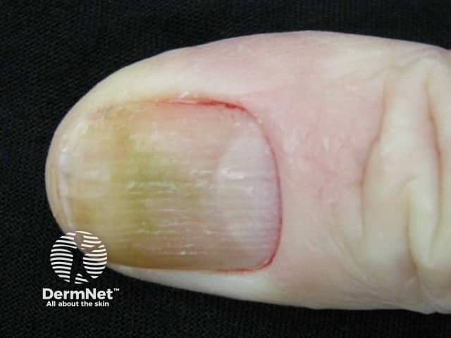 Onycholysis to artificial nail and methacrylate glue