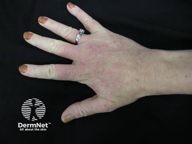 Hand dermatitis due to artificial nail and methacrylate glue