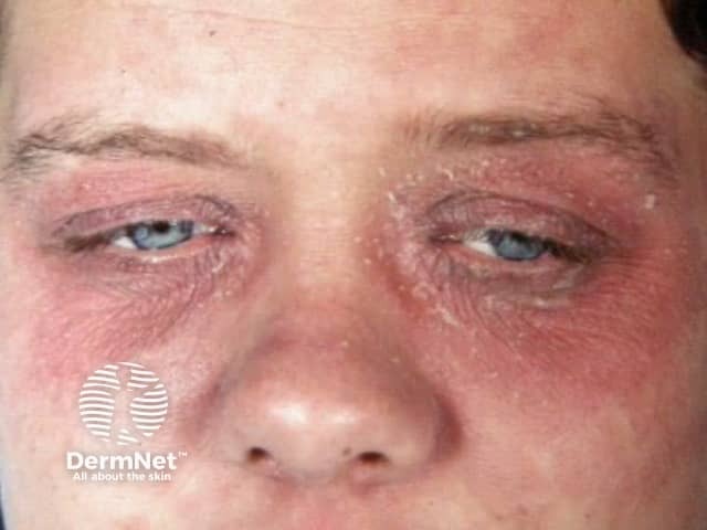 Eyelid dermatitis due to nail enamel allergy