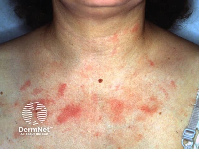 Chest dermatitis due to nail enamel allergy