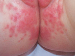 Napkin dermatitis thrush