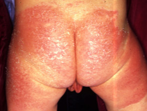 Napkin dermatitis