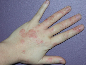 Hand Dermatitis Dermnet Nz
